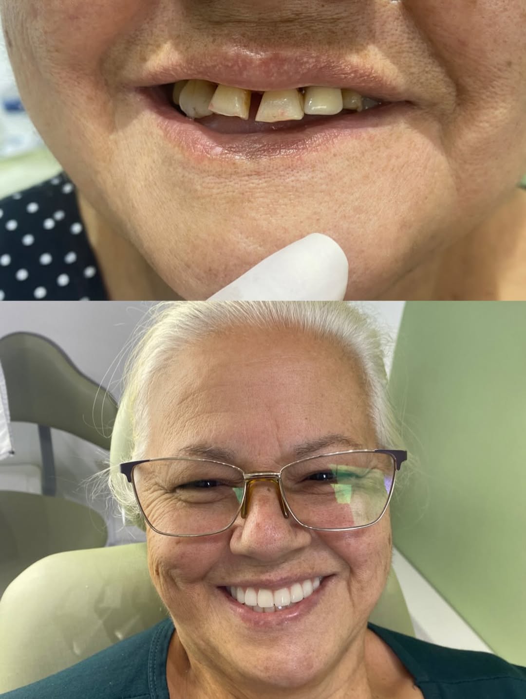 Prótese Dentária — antes e depois